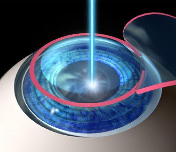 laser-eye-surgery