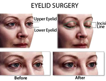 eyelid-surgery